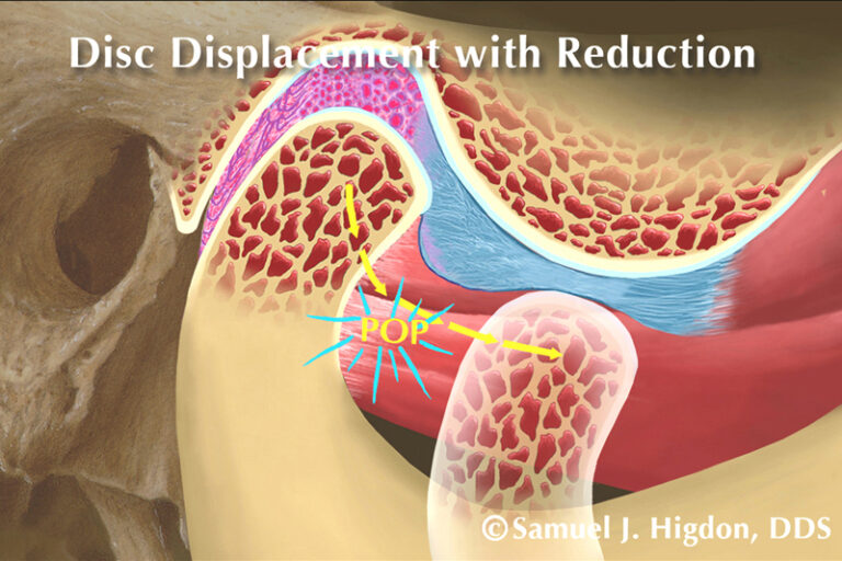 What Causes TMD? Mountains TMJ Dental Sleep Medicine
